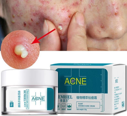 Onlineorderly™ ACNE Herbal Extract Cream for Clear and Healthy Skin